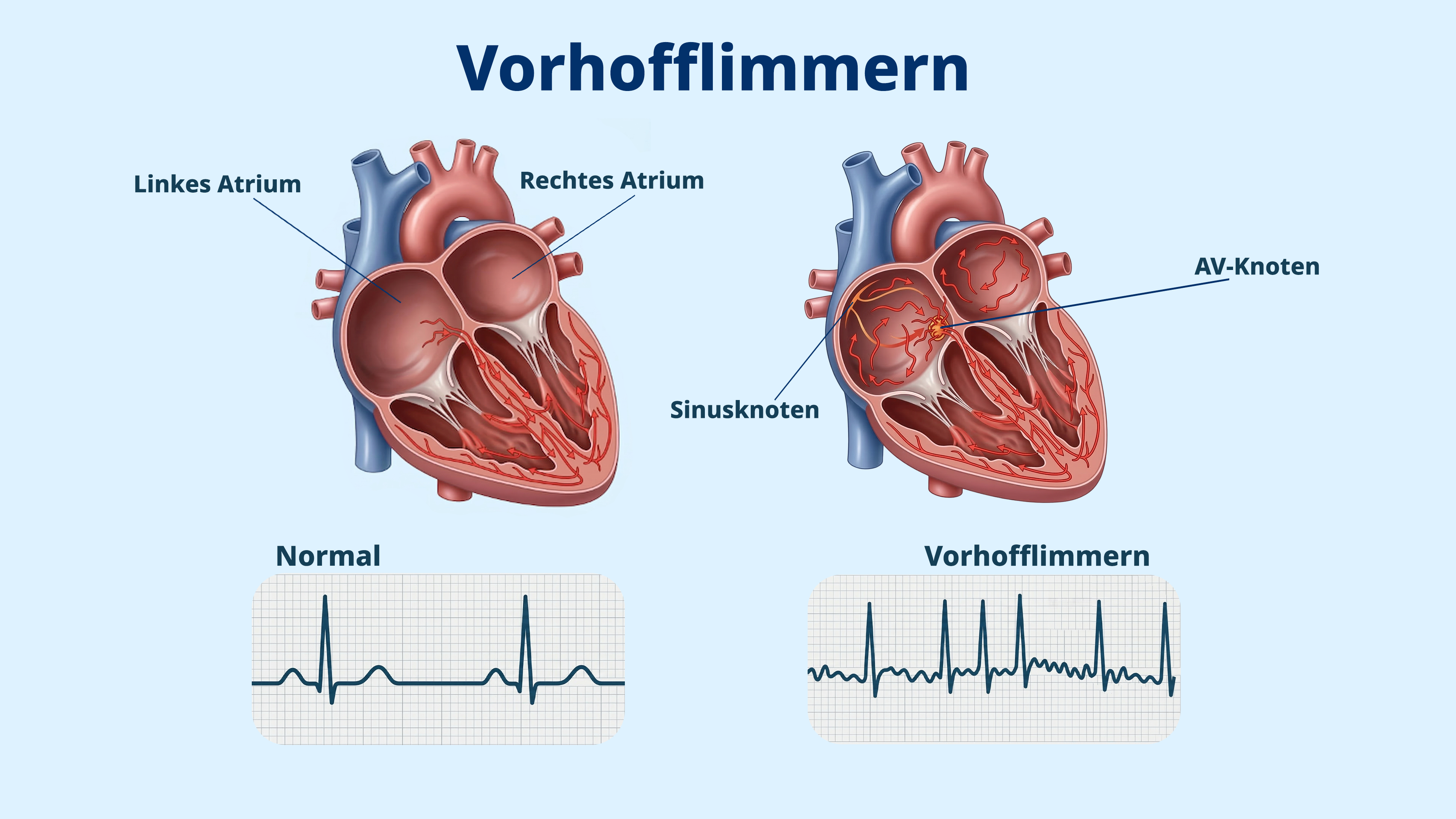 Medizinische Darstellung von normalem Herzschlag vs. Vorhofflimmern bei Übergewicht.
