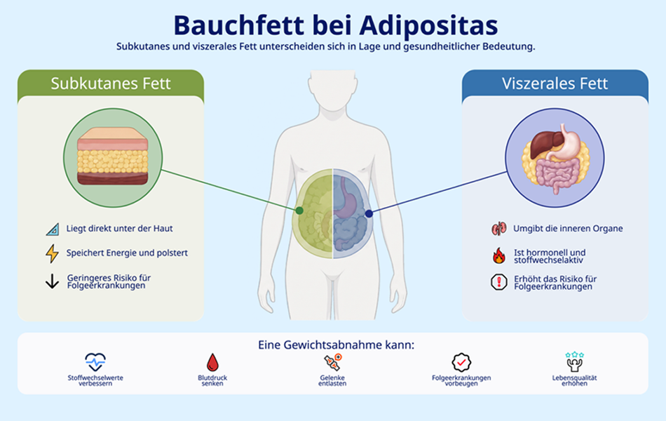 Infografik, die subkutanes und viszerales Bauchfett bei Adipositas vergleicht und mögliche Vorteile einer Gewichtsabnahme zeigt.