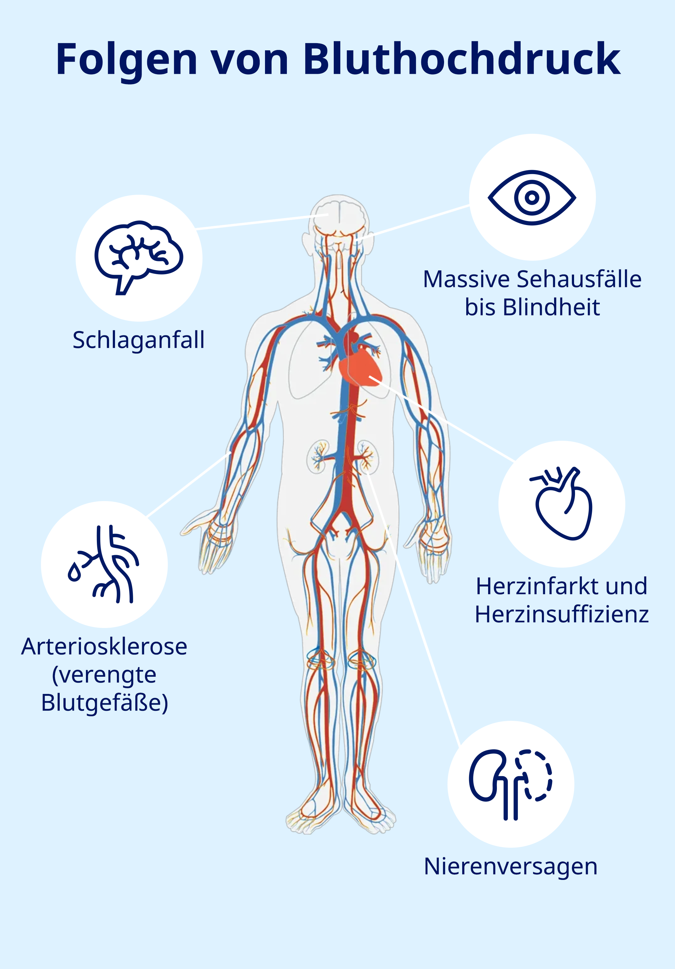 Bluthochdruck: Folgen auf einen Blick.