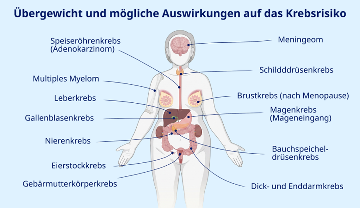 Übergewicht und Krebsarten als Überblicksgrafik. 